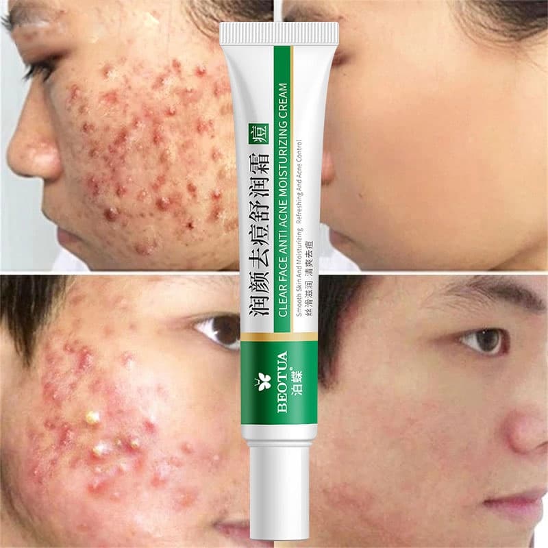 Eficaz Remoção De Acne Creme De Ervas Manchas Para Controle De Oleosidade Clareamento Hidratante Gel Facial Cuidados Com