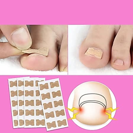 Adesivos Órtese para Correção de Unhas Encravadas | Manicure e Pedicure
