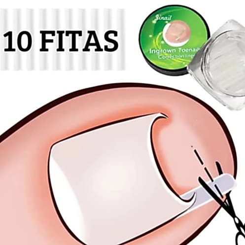 KIT 10 Fitas Órtese Para Unha Encravada Dedo Do Pé