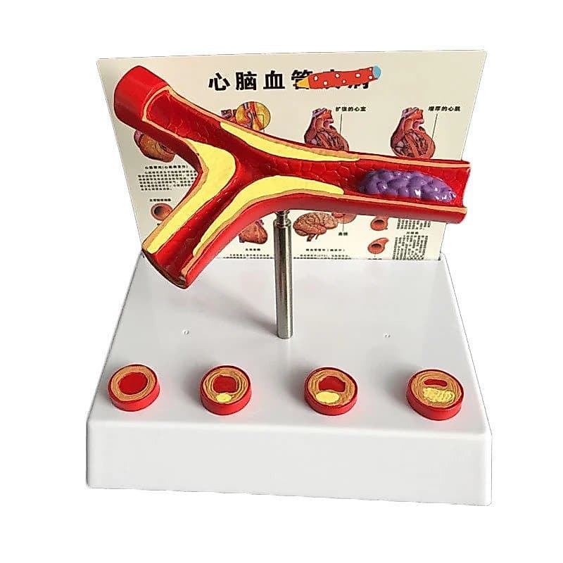 Modelo Vascular de Aterosclerose de Vaso Humano Ampliado 50 Vezes, Suprimentos de Laboratório CAPV