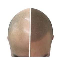 SOLUÇÃO MICROPIGMENTAÇÃO TEMPORÁRIA SKALP HAIR GROWTH PARA CAMUFLAR A CALVÍCIE/CARECA