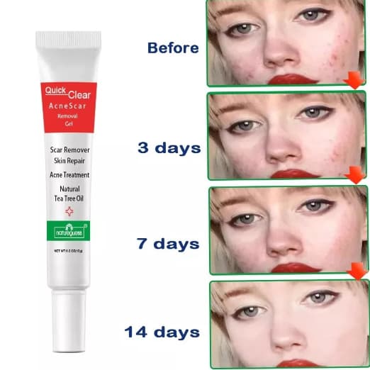 Creme  Para espinhas E  Cravos  Acne Pele Rosto
