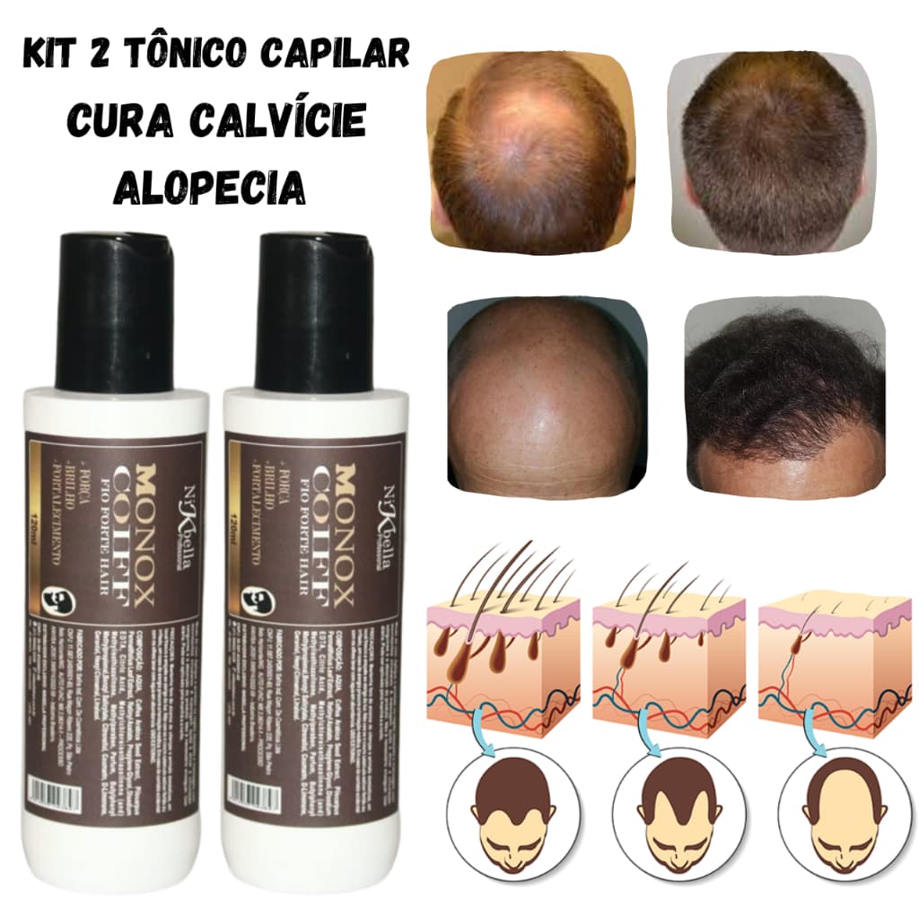 Kit Tratamento Capilar Tônico Anti Alopecia Areata