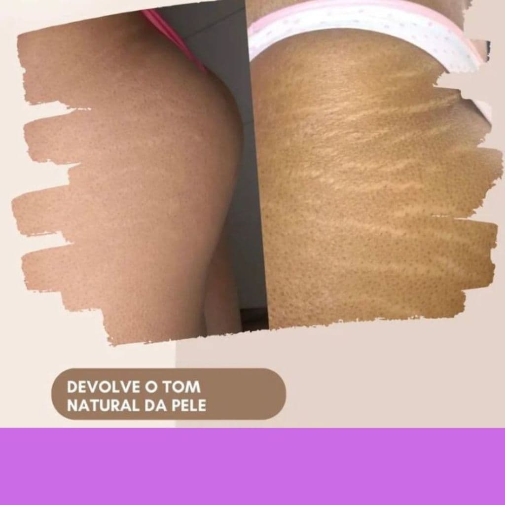 Gel creme anti-estrias Com Pimenta Negra