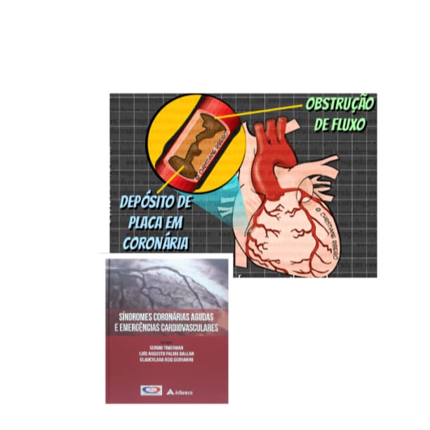 Síndromes Coronárias Agudas e Emergências Cardiovasculares Capa dura  Edição Português doença coronária morbimortalidade