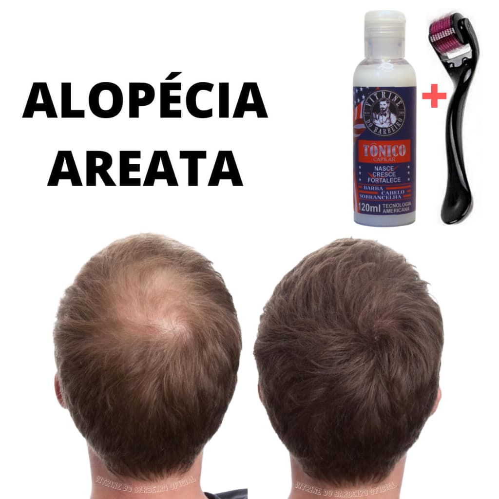 Dermaroller + Tônico Kit Para Queda Fibrosante De Cabelo Unissex