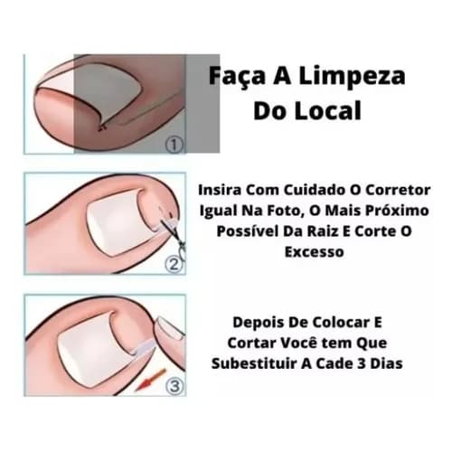 10 Corretor Unha Encravada Formato C Almofada Tubular