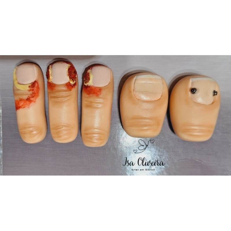 kit escultura de dedos em Biscuit Onicocriptose unha encravada