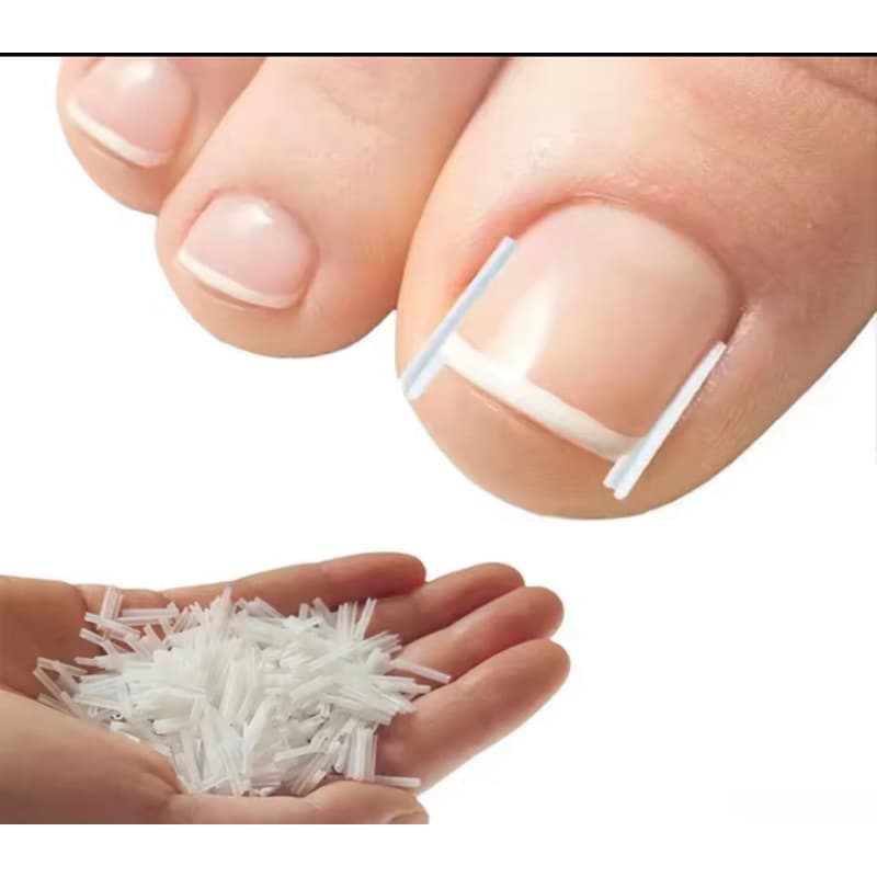 kit de correção de unha encravada podologia corretor pedicure acessório podólogo