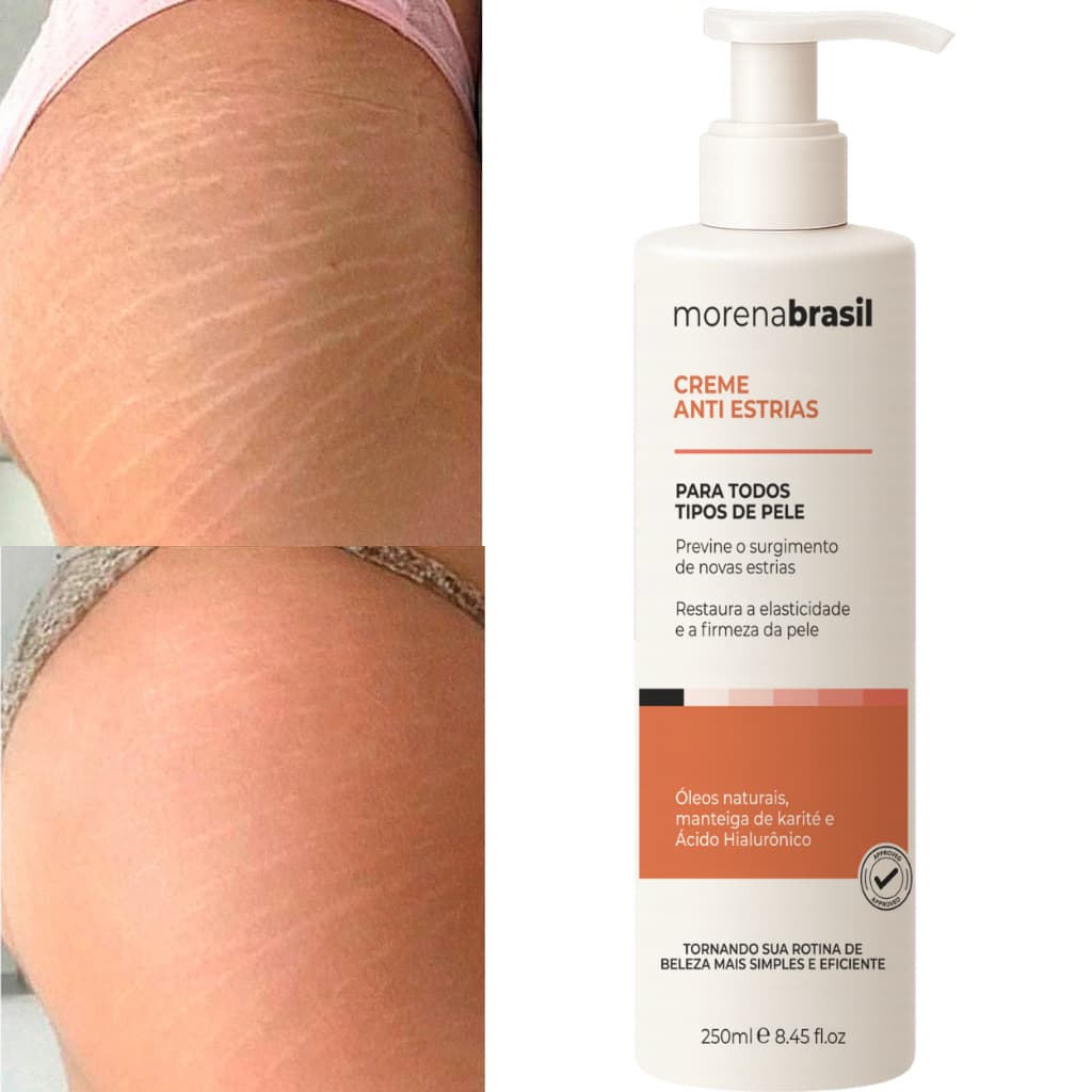 Creme Anti-Estrias Morena Brasil | Previne novas estrias: Reforça a elasticidade da pele!!