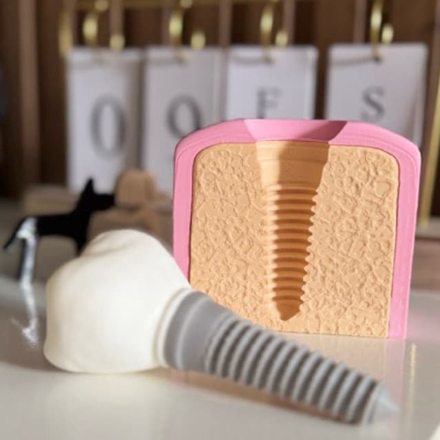 Enfeite Dente com implante - Odontologia - Decoração de consultório