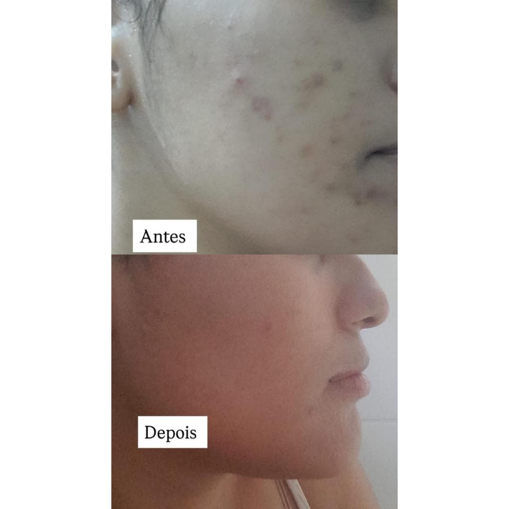 Sabonete Pele Porcelana/Ajuda Clarear Manchas Acne/Axilas e Virilha/  Facial e Corporal/Sabonete para Clarear Pele