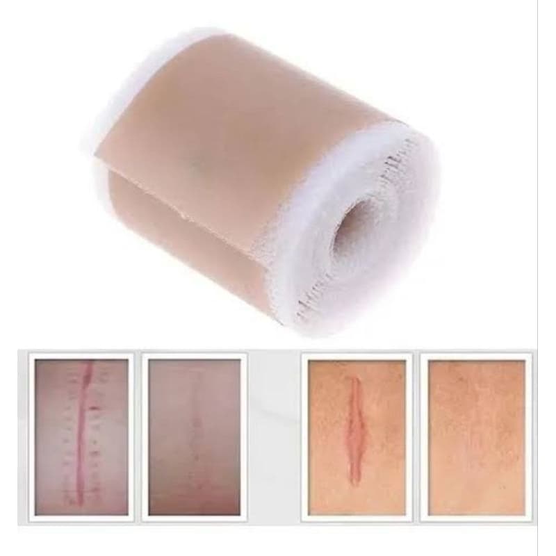 1 Pcs Terapia Da Folha Do Gel Silicone Remoção Cicatriz Cirurgia De Para O Tratamento