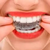 Protetor Bucal Silicone Moldável Anti Desgaste Dos Dentes Confort