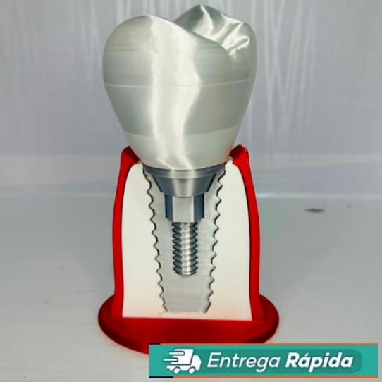 Modelo Anatômico Implante Dentário com Dente | Odontologia para Dentistas, Clínicas e Estudo