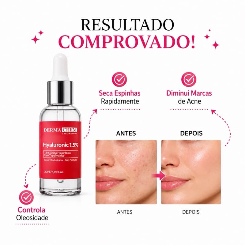 Sérum Facial Anti Acne e Clareador – Niacinamida + Ácido Hialurônico Hidratante