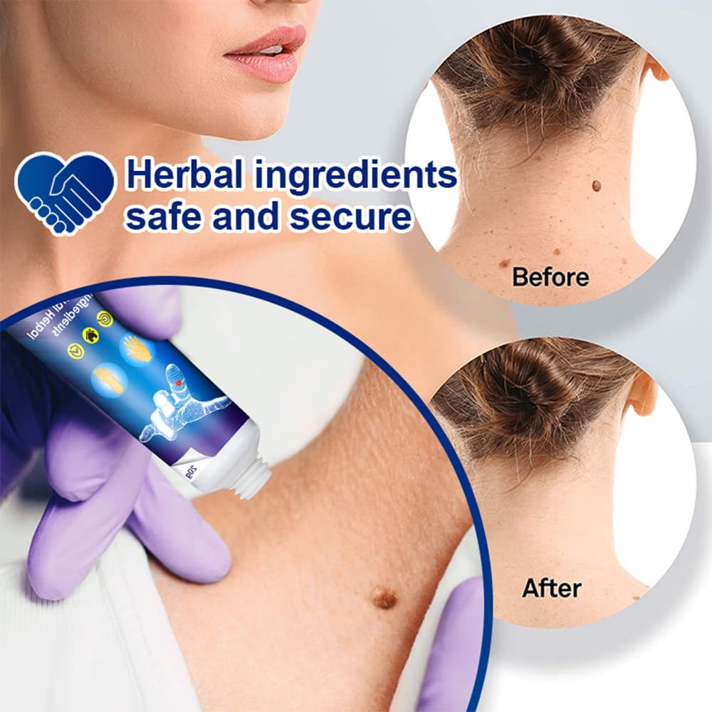 Creme Anti-Verrugas Para Sardas Suaviza Calos Hidratante Proteção Da Pele