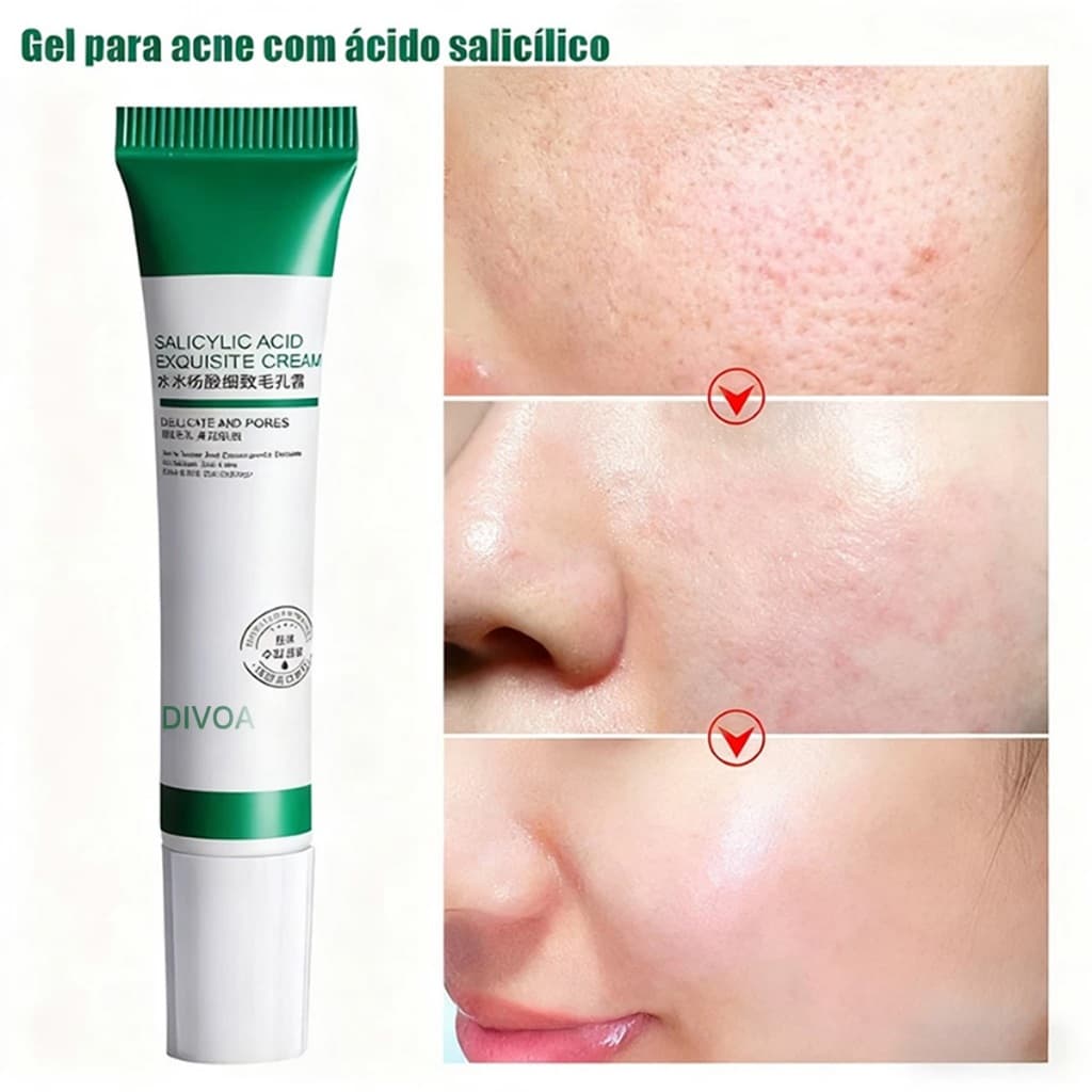 Creme de Ácido Salicílico para Redução de Poros - Loção Facial Hidratante Redução de Poros Dilatados