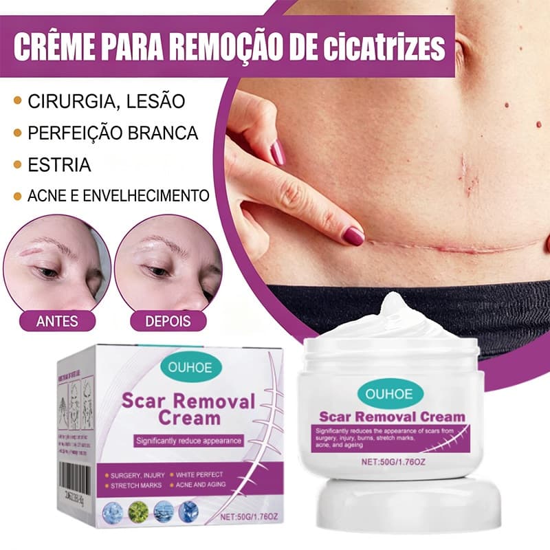 Creme Para Remoção De Cicatrizes : Desbota Cirúrgicas , Queimaduras , Repara Hipertróficas E Queloides , Achata Elevadas