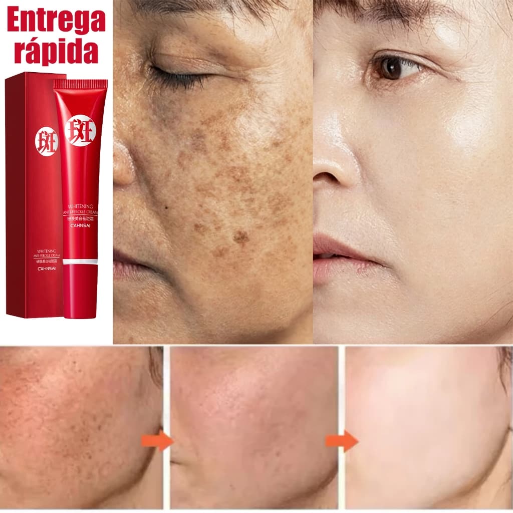 20g Creme Clareador de Manchas,Creme anti-rugas,para cuidados com a pele/iluminação da pele,Reduzir marcas de acne