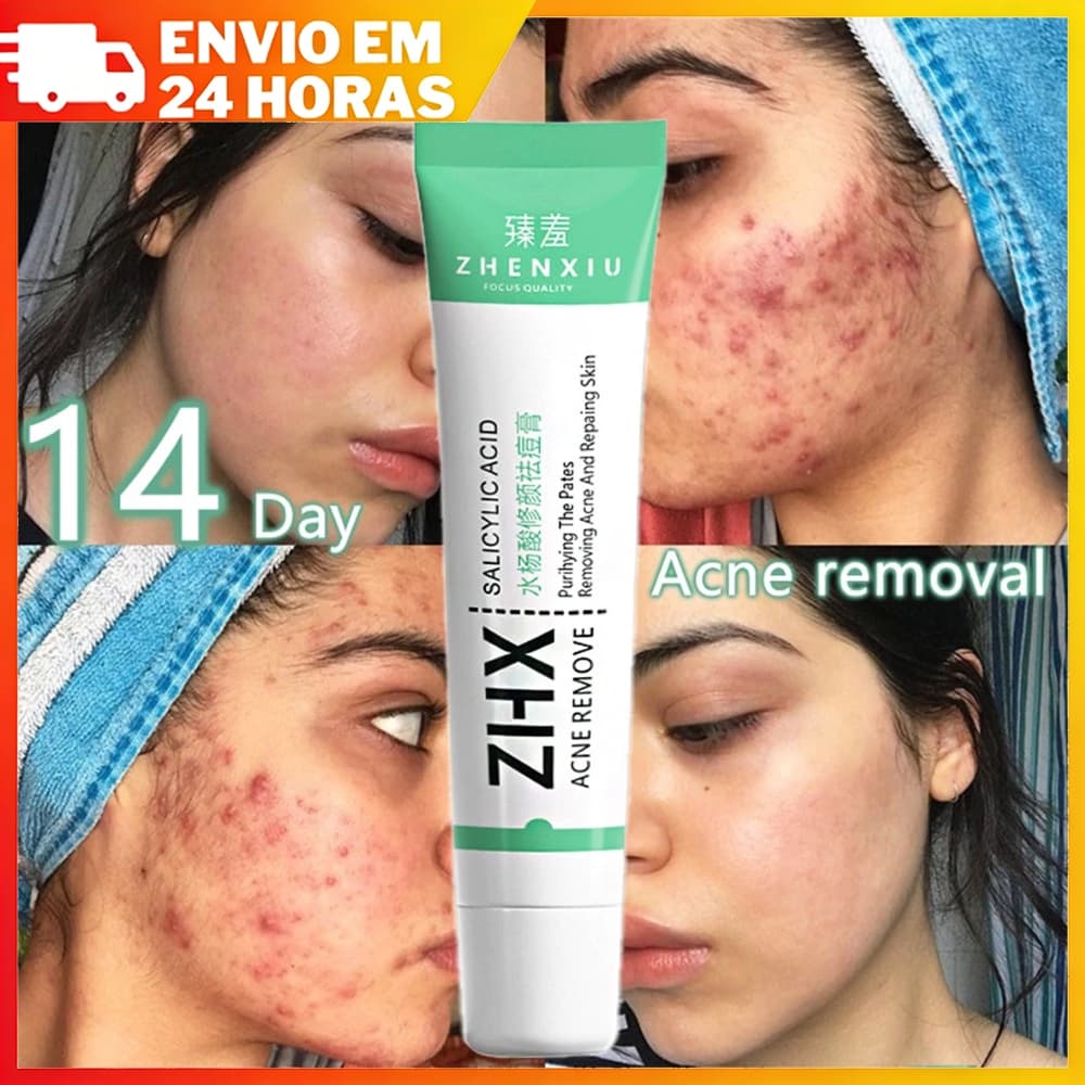 Ácido Salicílico Acne Creme Remover Cravo Controle De Óleo Anti-Tratamento Reparação Cicatriz Clareamento Facial