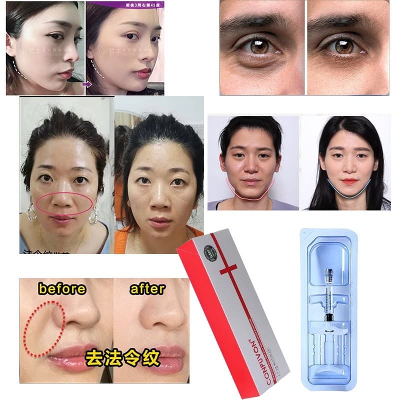 Comwort ácido hialurônico de sódio Gel ácido hialurônico grande médio pequeno moléculas Facial pele de maçã templo lábio