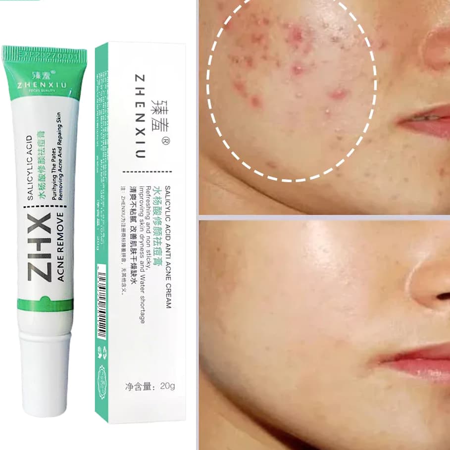 Ácido Salicílico Acne Creme Remover Cravo Controle De Óleo Anti-Tratamento Reparação Espinha Cicatriz Clareamento Facial