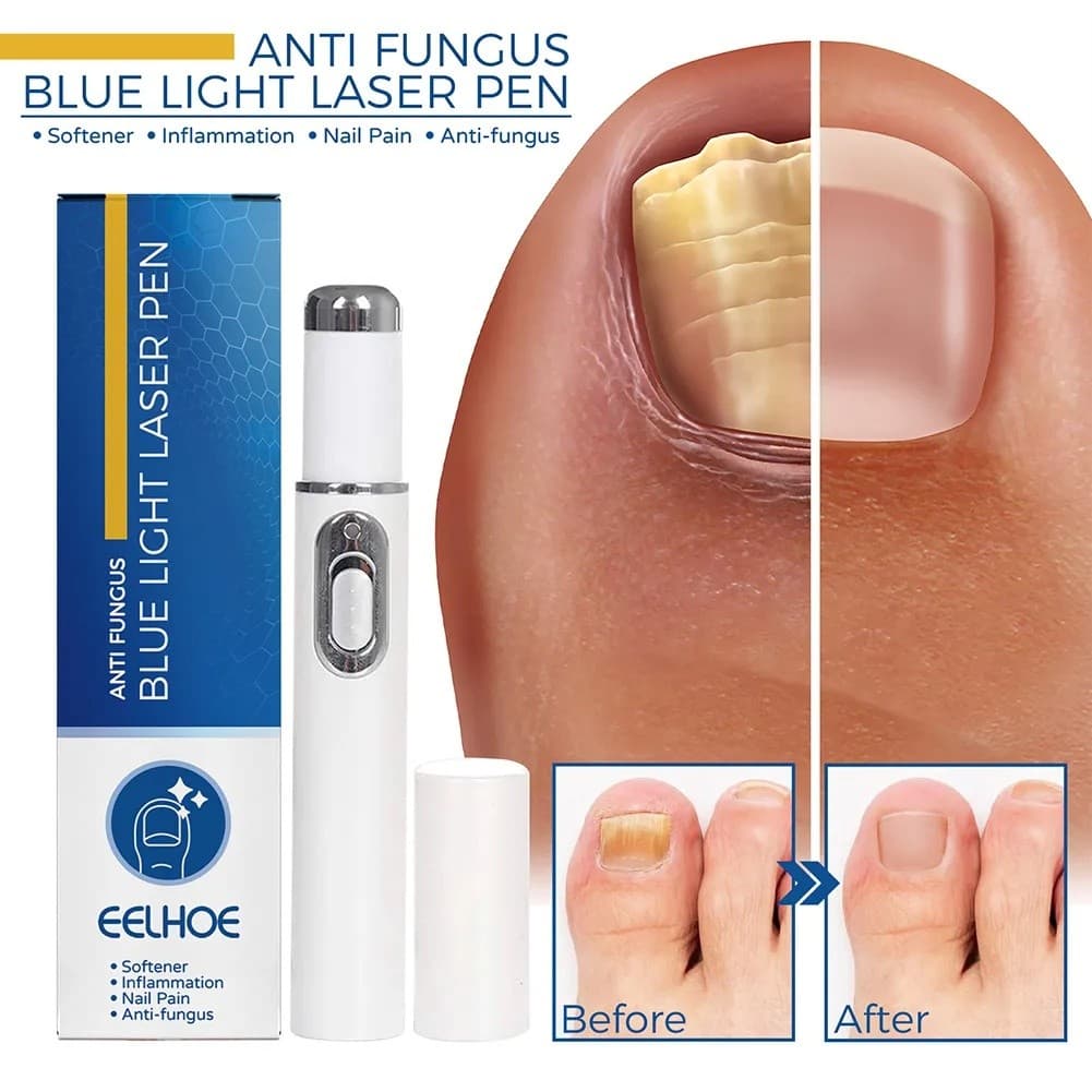 1 Pcs Caneta De Tratamento De Fungos De Unhas Reparação Antifúngico Laser Azul Parony Onicomicose Kit Sem Dor