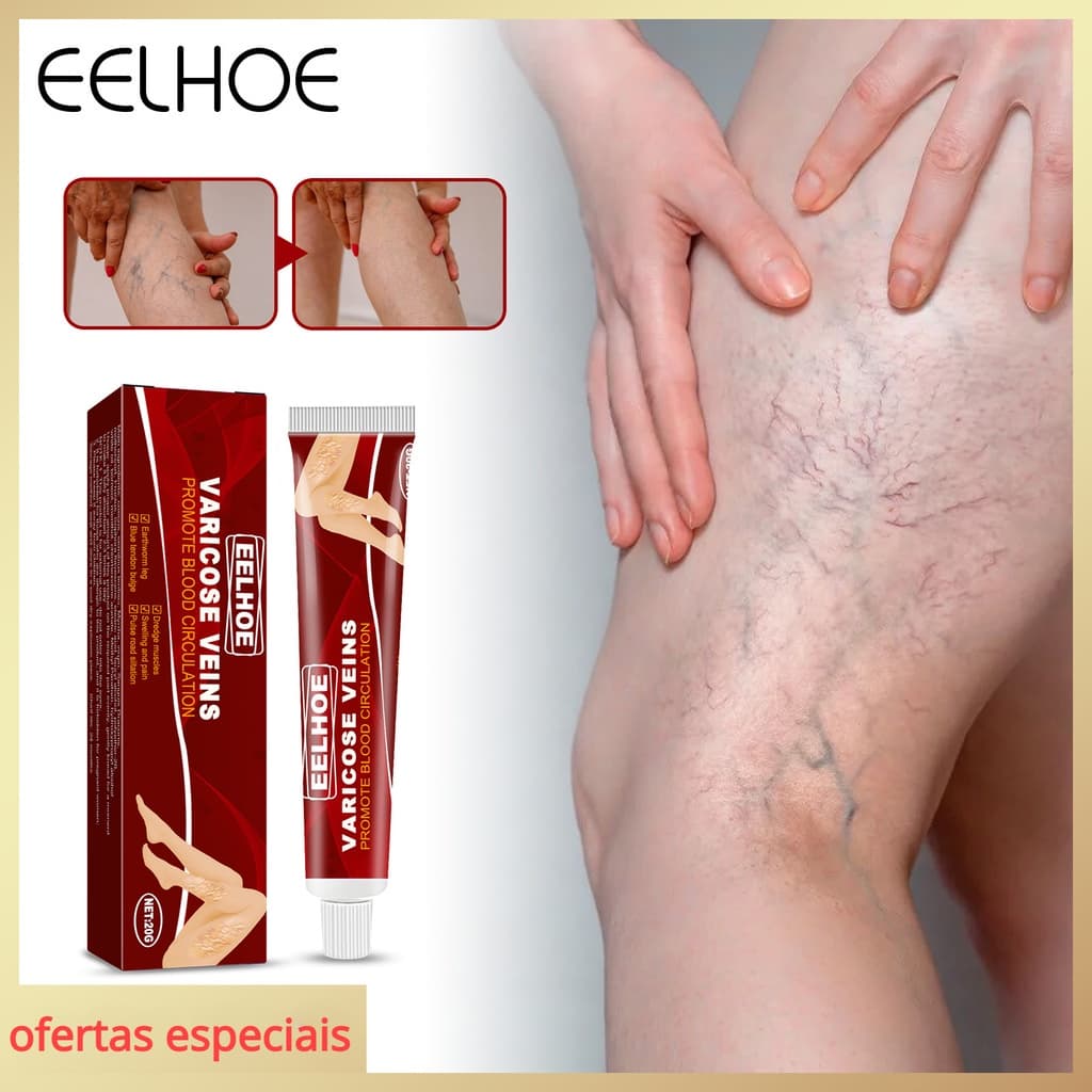 Creme De Alívio De Varizes , Alivia A Vasculite Das Pernas Phlebitis Fatigue Veins