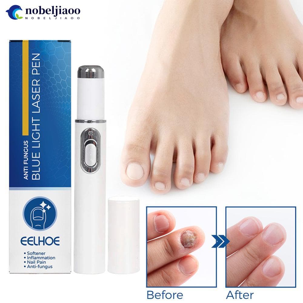 NOBELJIAOO Caneta Laser De Luz Azul Onychomycosis Reparo Restauração Da Saúde Das Unhas Remoção Do Odor Ferramenta De Tratamento H2R2