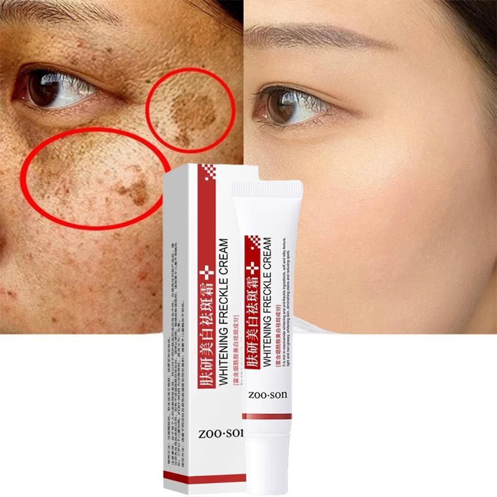 Creme Branqueador Para Remover Pontos Melasma/Escuros/Melanina/Shine
