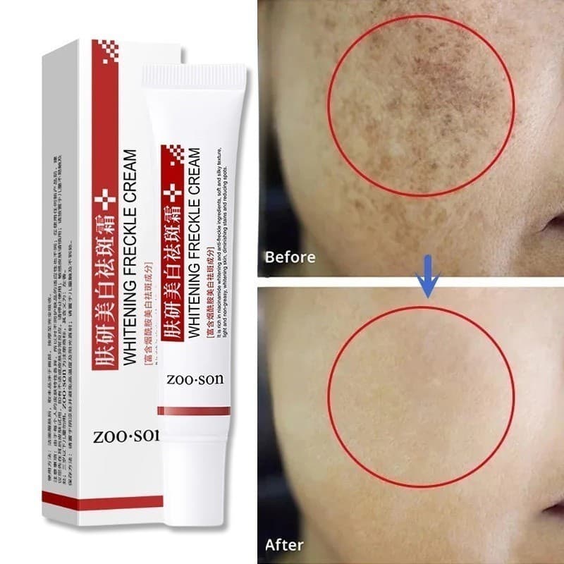 Creme Clareador Para Remover Melasma , Manchas Escuras , Melanina , Pele Brilhante