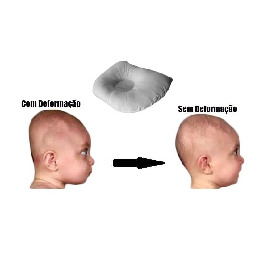 Travesseiro Plagiocefalia Para Bebe Cabeça Chata