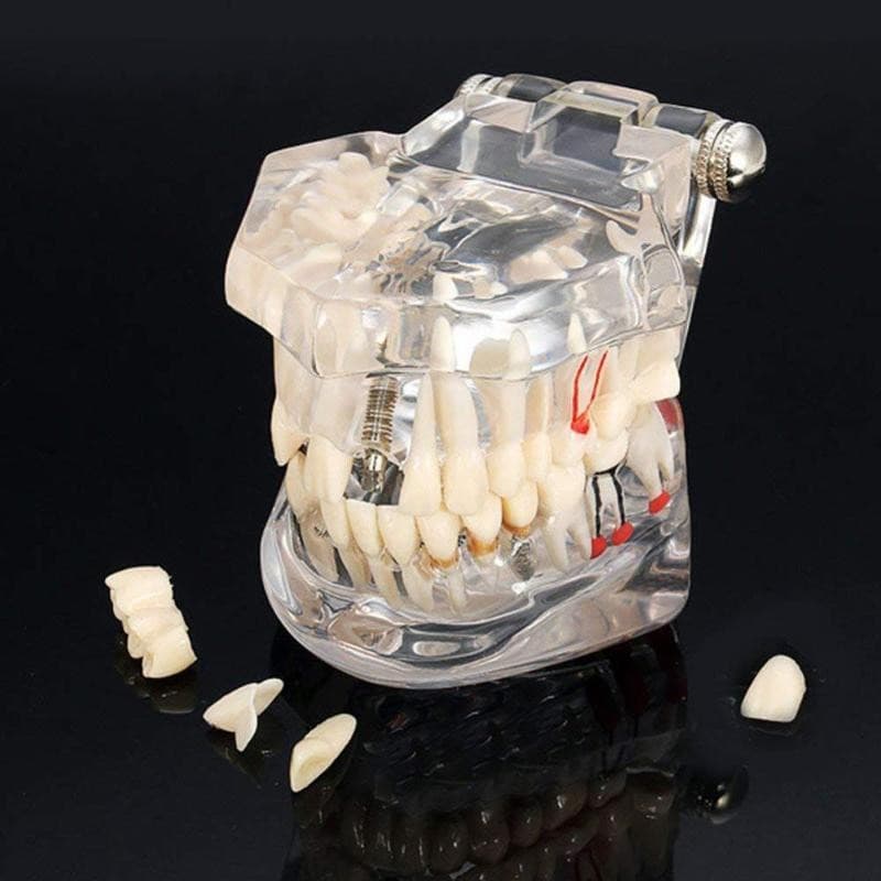 Macro Modelo Odontológico - Implantes Canal Provisorios