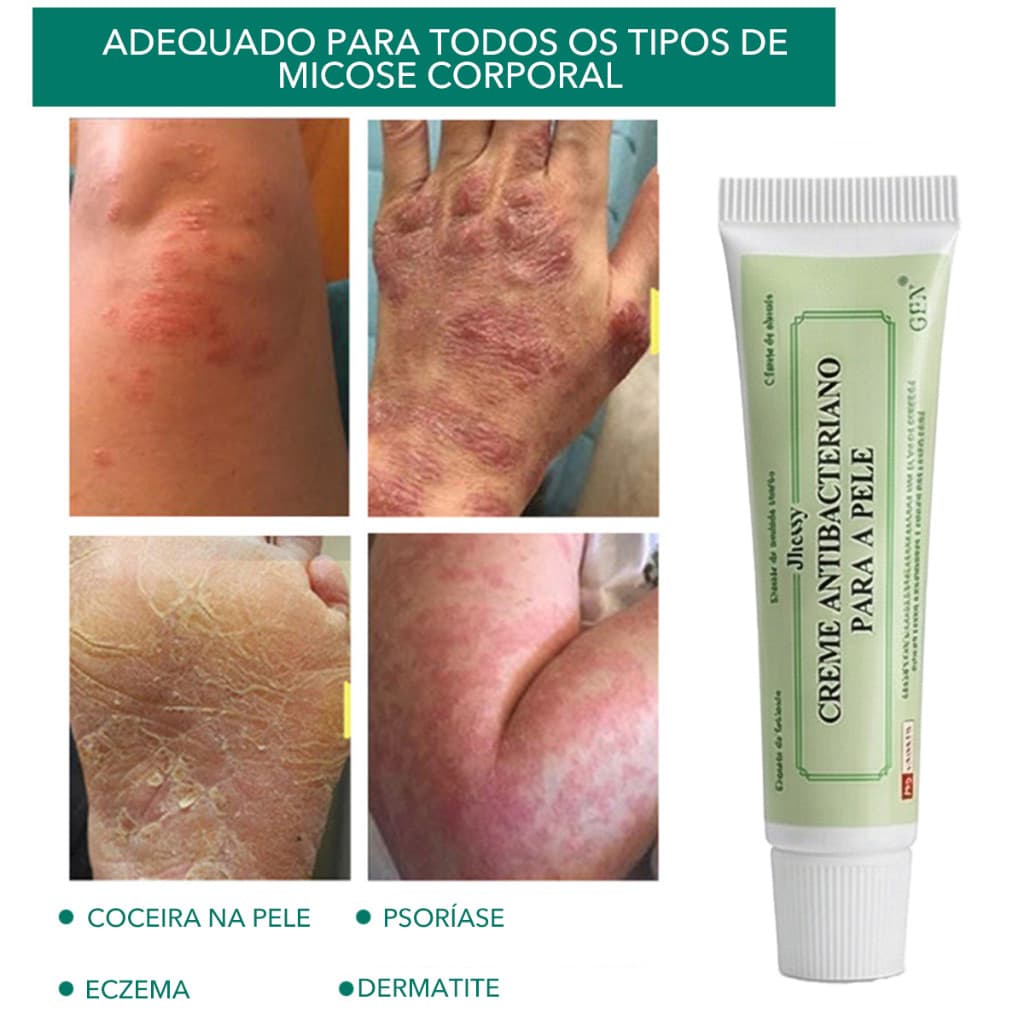 Creme Para A Pele , Antibacteriano Eczema Nu , Pomada Dermatite Eczematoide , Cuidado Com Inibição De Aprendizagem Volu