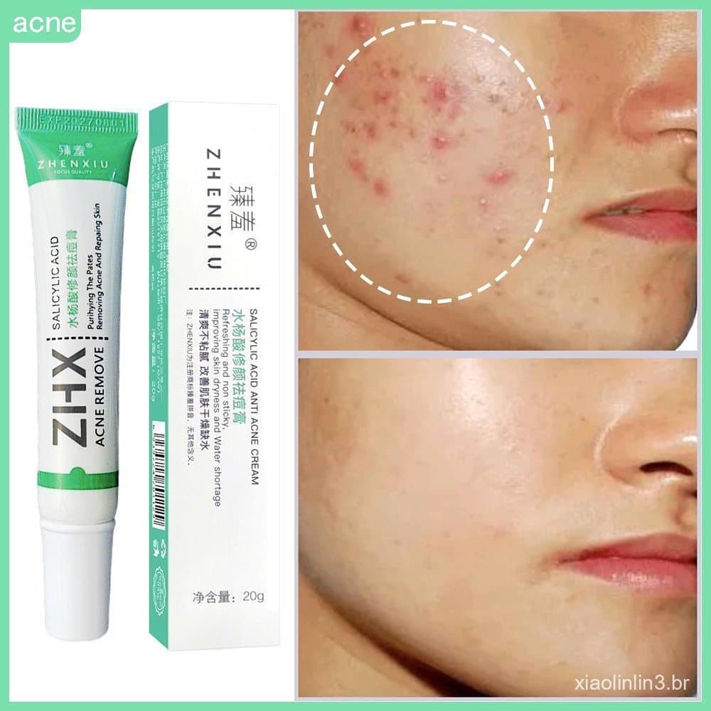 Creme para remoção de Acne com ácido salicílico, Remove óleo e Remove cravos, melhora o clareamento
