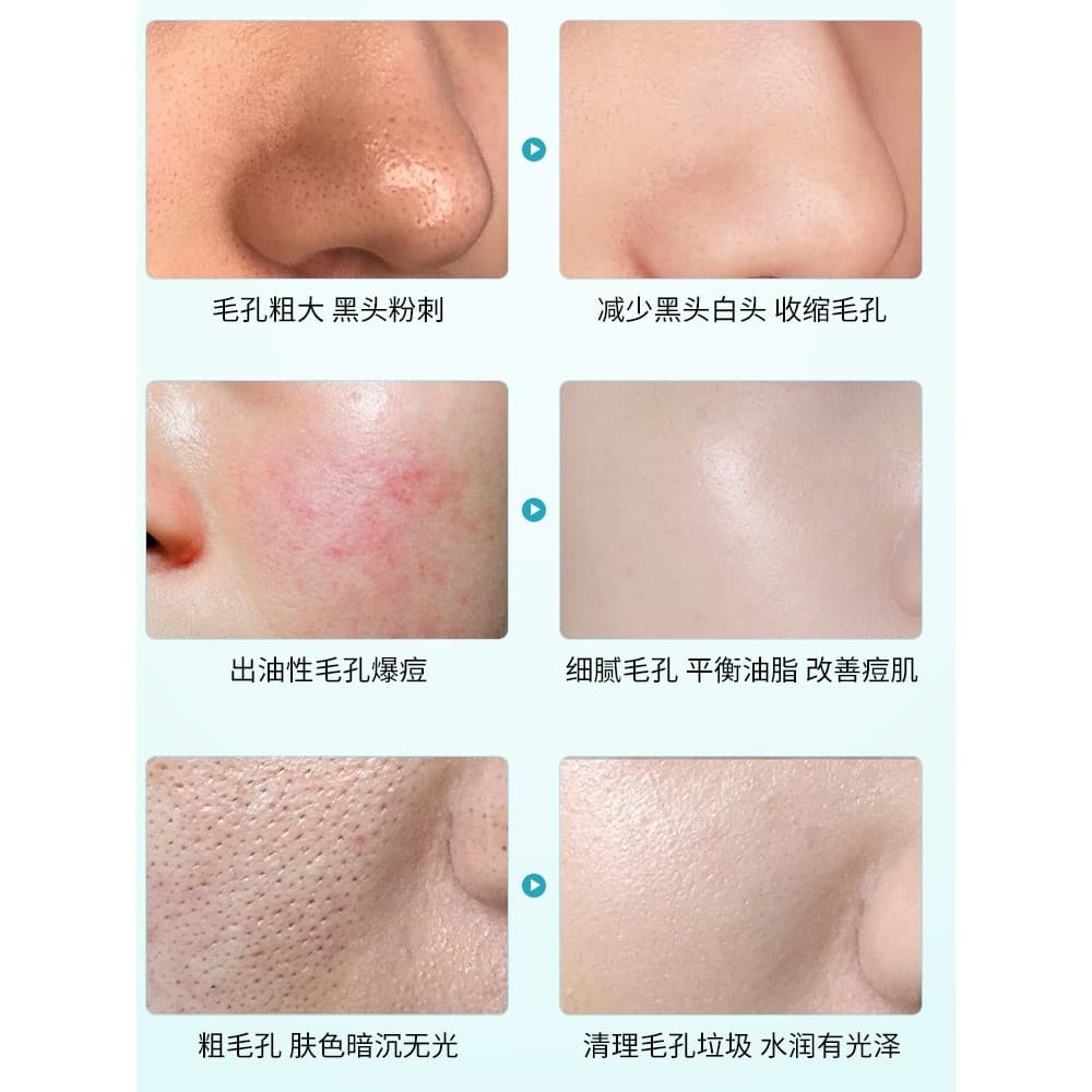 Compre 2 e ganhe 1 grátis [Recomendação de venda quente] Não esprema, deixe-Me sugar coisas sujas, remover lixo Facial d