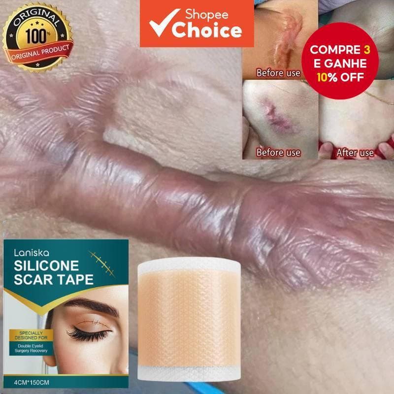 Adesivo de Silicone para Remoção de Cicatrizes, Acne e Estrias, Tratamento e Reparação, Cuidado para Pele Lisa
