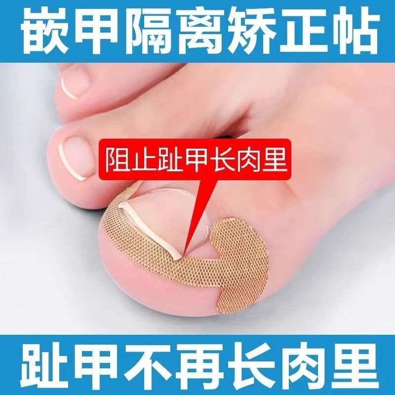 Adesivo positivo para unhas, junta de ranhura para unhas encravadas, corretor especial de unhas, ferramenta útil para on