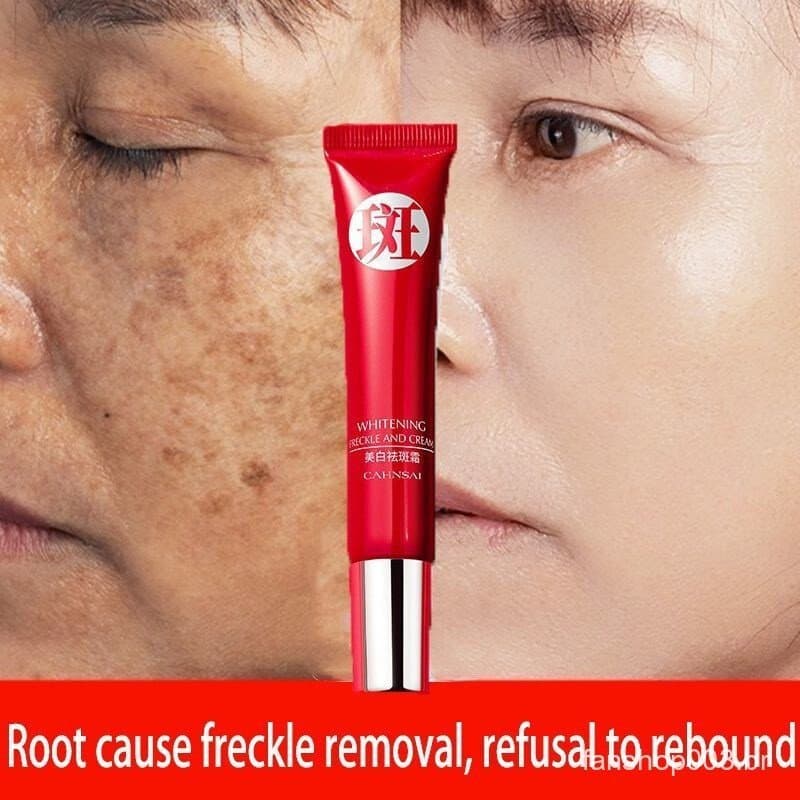 Creme forte original para remover manchas escuras/clareamento pigmentado/cuidados com a pele QRJZ VQGA