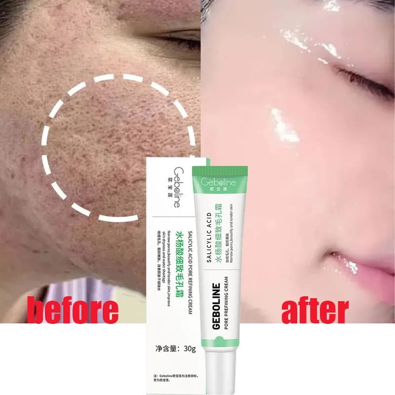 Creme de Ácido Salicílico para Redução de Poros, Aperto Facial, Produto de Cuidado da Pele Suave Coreano TJ3M