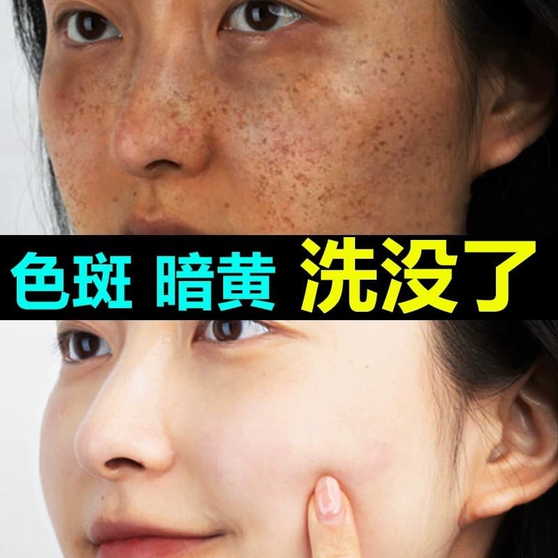 Clareamento remoção de sardas limpador Facial amarelo limpador de pele das mulheres dos homens dedicados manchas de desb