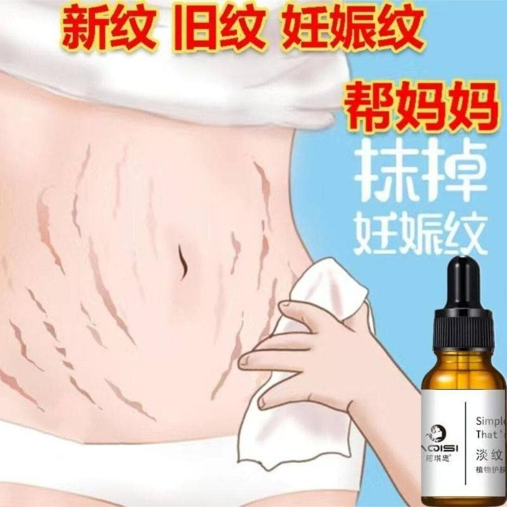 [As linhas são Gone] Remova linhas finas, linhas especiais para linhas elásticas de obesidade Chen, linhas de cresciment