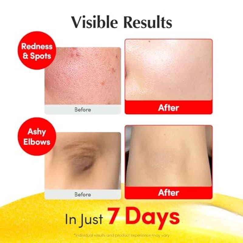 Ácido Vitamínico | Vitamina C 4 % Tom Irregular Escuro & amp ; 1.0 + Soro Iluminador Para Cuidados Com A Pele , Ponto ,