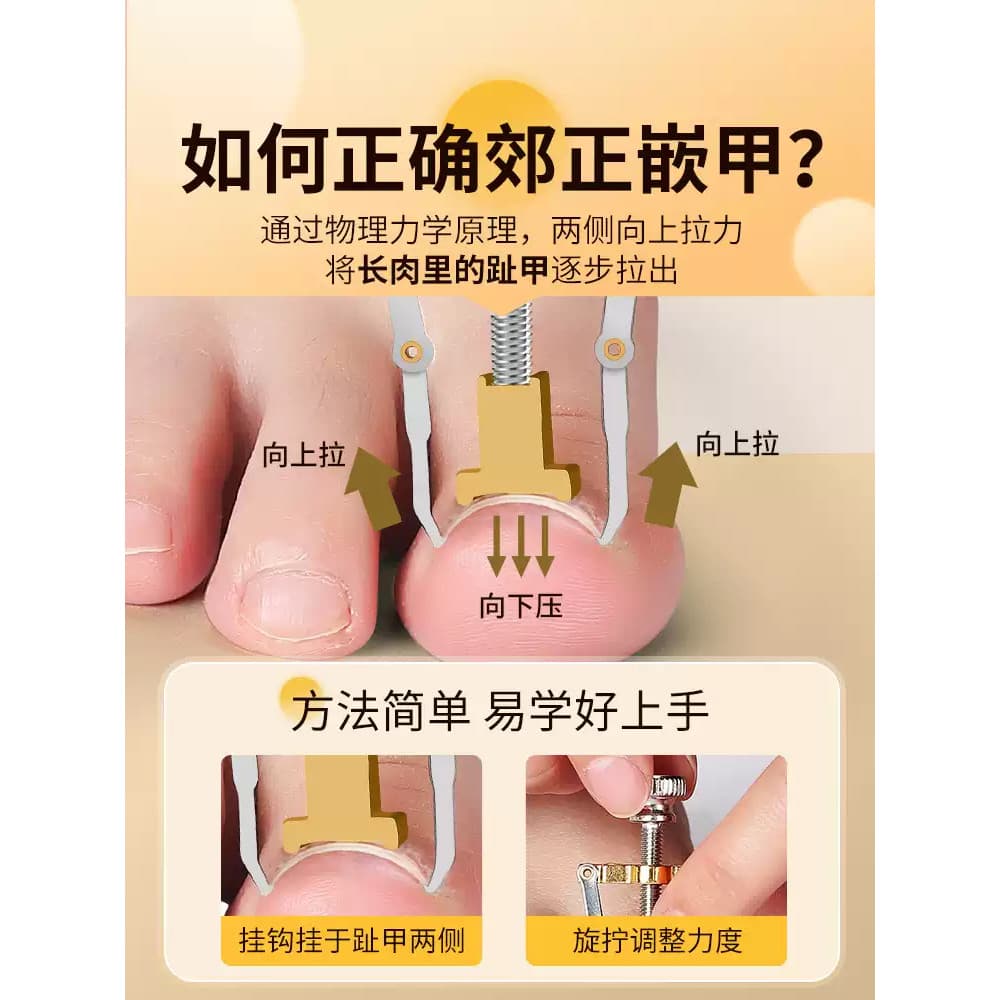 Corretor de unhas encravadas, corretor de unhas, ondulação de unhas, ferramenta útil, Anti-toe, ferramenta especial de P