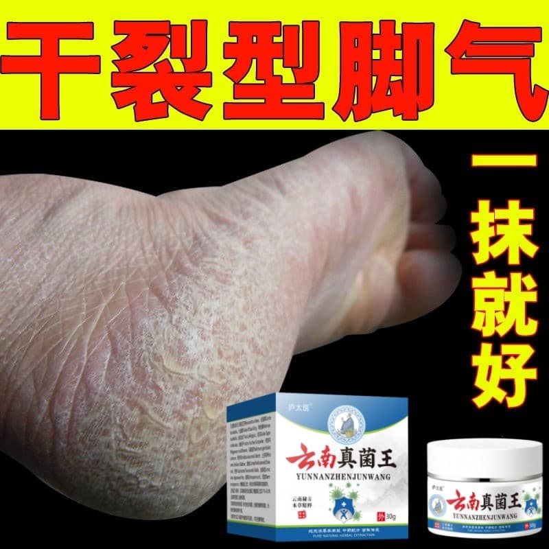 Keratinizado pé calcanhar rachaduras secas rachaduras aliviar coceira Peeling infecção de fungo engrossado endurecido at