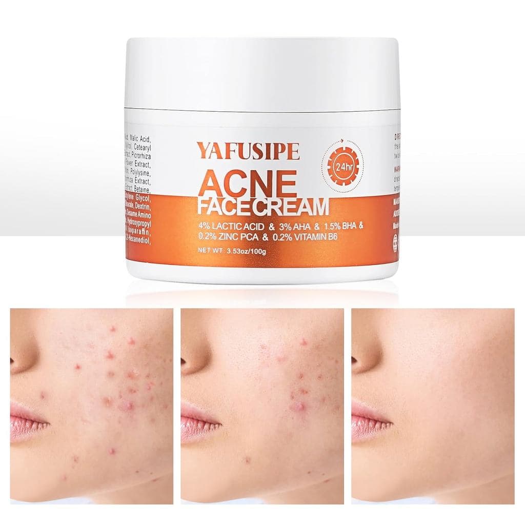 Tratamento para Acne no Rosto para Acne Hormonal Cístico Persistente, Creme para Pele Sensível, Adolescentes, Adultos, M