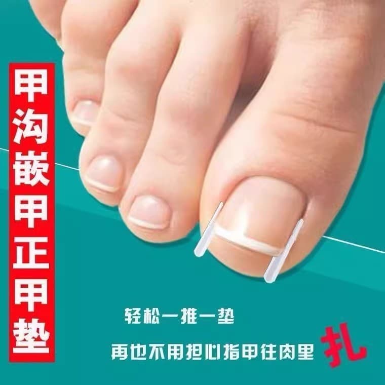Corretor de unhas inflamação ferramenta útil adesivo de unhas remendo de unhas encravadas unha longa correção junta de e