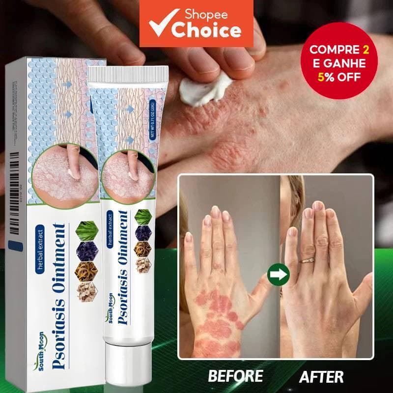 Creme Antibacteriano para Psoríase Lua do Sul Ervas Eficaz Alívio Anti-coceira Tratamento Dermatite Urticária -