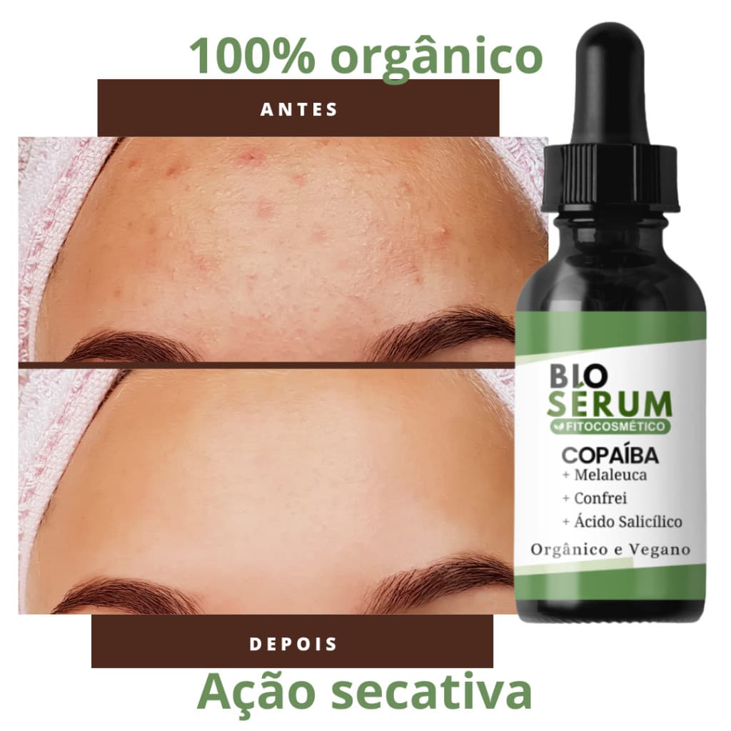 Sérum Secativo Copaíba e Melaleuca 30ml Auxilia no Controle da Oleosidade e Acne